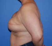 Patient 689 - Surgery 1 Photo 1 - Tissue Expander Implant Latissimus Muscle - Breast Cancer Texas