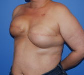 Patient 689 - Surgery 1 Photo 2 - Tissue Expander Implant Latissimus Muscle - Breast Cancer Texas