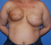 Patient 689 - Surgery 1 Photo 3 - Tissue Expander Implant Latissimus Muscle - Breast Cancer Texas