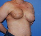 Patient 689 - Surgery 1 Photo 4 - Tissue Expander Implant Latissimus Muscle - Breast Cancer Texas