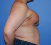 Patient 689 - Surgery 1 Photo 5 - Tissue Expander Implant Latissimus Muscle - Breast Cancer Texas