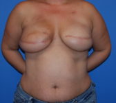 Patient 689 - Surgery 2 Photo 3 - Tissue Expander Implant Latissimus Muscle - Breast Cancer Texas