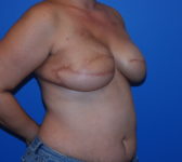 Patient 689 - Surgery 2 Photo 4 - Tissue Expander Implant Latissimus Muscle - Breast Cancer Texas