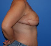 Patient 689 - Surgery 2 Photo 5 - Tissue Expander Implant Latissimus Muscle - Breast Cancer Texas