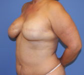 Patient 689 - Surgery 3 Photo 2 - Tissue Expander Implant Latissimus Muscle - Breast Cancer Texas