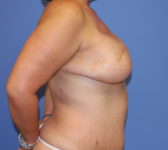 Patient 689 - Surgery 3 Photo 5 - Tissue Expander Implant Latissimus Muscle - Breast Cancer Texas