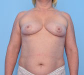 Patient 7 Before Surgey Photo 3 - Nipple Sparing Mastectomy Tissue Expander Implant - Breast Cancer Texas