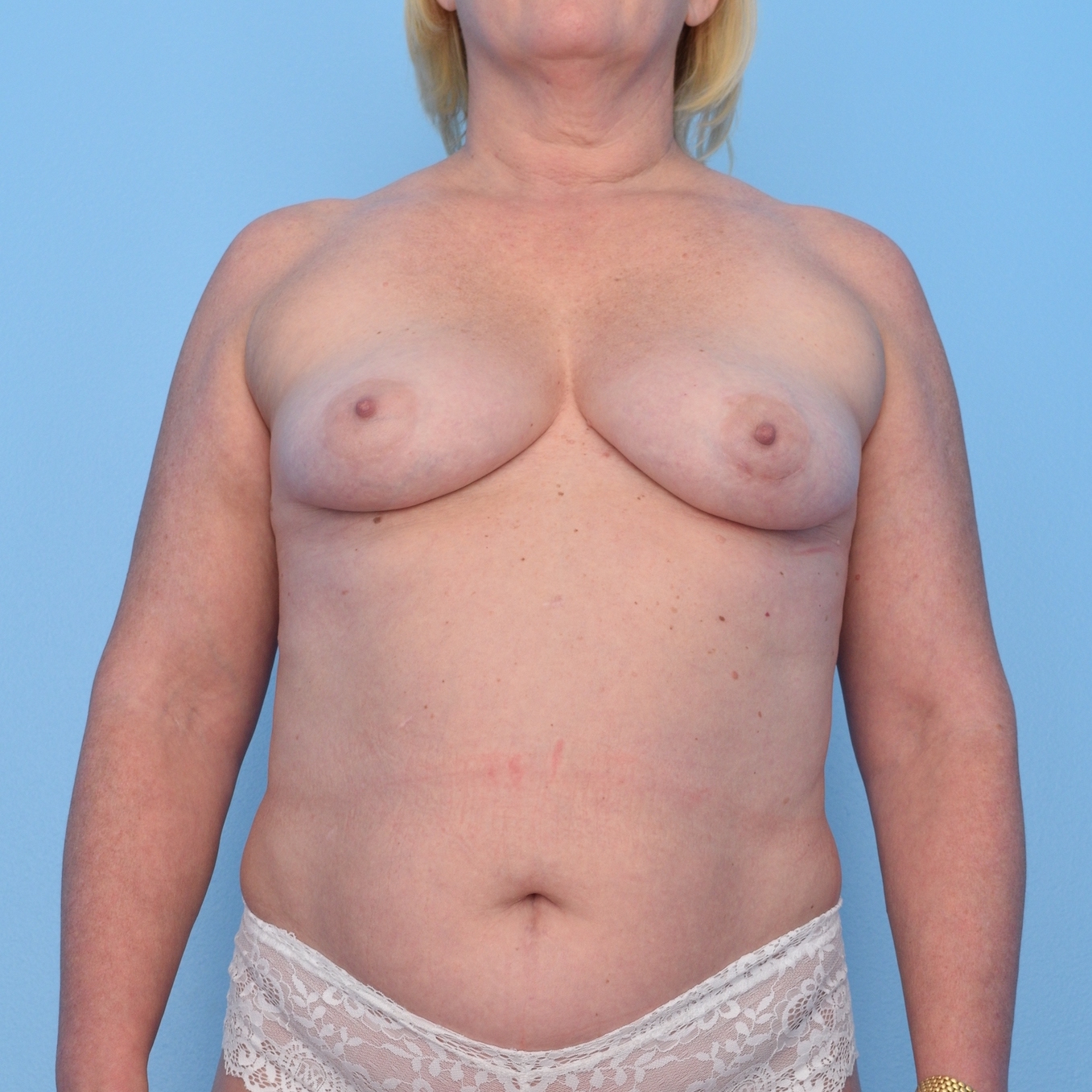 Patient 7 Before Overview - Sidebar - Nipple Sparing Mastectomy Tissue Expander Implant - Breast Cancer Texas