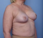 Patient 7 - Surgery 1 Photo 4 - Nipple Sparing Mastectomy Tissue Expander Implant - Breast Cancer Texas