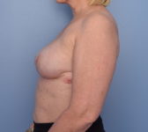 Patient 7 - Surgery 2 Photo 1 - Nipple Sparing Mastectomy Tissue Expander Implant - Breast Cancer Texas