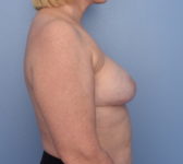 Patient 7 - Surgery 2 Photo 5 - Nipple Sparing Mastectomy Tissue Expander Implant - Breast Cancer Texas