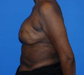 Patient 344 Before Surgey Photo 1 - Revisional Breast Surgery Tissue Expander Implant Latissimus Muscle - Breast Cancer Texas