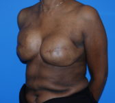 Patient 344 Before Surgey Photo 2 - Revisional Breast Surgery Tissue Expander Implant Latissimus Muscle - Breast Cancer Texas