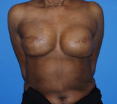 Patient 344 Before Surgey Photo 3 - Revisional Breast Surgery Tissue Expander Implant Latissimus Muscle - Breast Cancer Texas