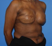 Patient 344 Before Surgey Photo 4 - Revisional Breast Surgery Tissue Expander Implant Latissimus Muscle - Breast Cancer Texas