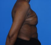 Patient 344 Before Surgey Photo 5 - Revisional Breast Surgery Tissue Expander Implant Latissimus Muscle - Breast Cancer Texas