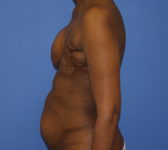 Patient 344 - Surgery 1 Photo 1 - Revisional Breast Surgery Tissue Expander Implant Latissimus Muscle - Breast Cancer Texas