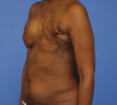 Patient 344 - Surgery 1 Photo 2 - Revisional Breast Surgery Tissue Expander Implant Latissimus Muscle - Breast Cancer Texas