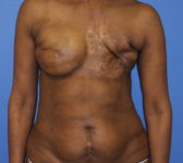 Patient 344 - Surgery 1 Photo 3 - Revisional Breast Surgery Tissue Expander Implant Latissimus Muscle - Breast Cancer Texas