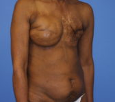 Patient 344 - Surgery 1 Photo 4 - Revisional Breast Surgery Tissue Expander Implant Latissimus Muscle - Breast Cancer Texas