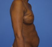 Patient 344 - Surgery 1 Photo 5 - Revisional Breast Surgery Tissue Expander Implant Latissimus Muscle - Breast Cancer Texas