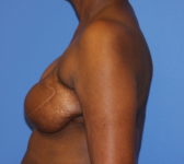 Patient 344 - Surgery 2 Photo 1 - Revisional Breast Surgery Tissue Expander Implant Latissimus Muscle - Breast Cancer Texas