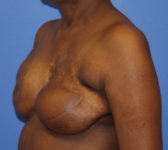 Patient 344 - Surgery 2 Photo 2 - Revisional Breast Surgery Tissue Expander Implant Latissimus Muscle - Breast Cancer Texas