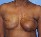 Patient 344 - Surgery 2 Photo 3 - Revisional Breast Surgery Tissue Expander Implant Latissimus Muscle - Breast Cancer Texas