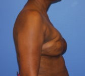 Patient 344 - Surgery 2 Photo 5 - Revisional Breast Surgery Tissue Expander Implant Latissimus Muscle - Breast Cancer Texas