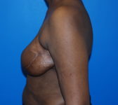 Patient 344 - Surgery 3 Photo 1 - Revisional Breast Surgery Tissue Expander Implant Latissimus Muscle - Breast Cancer Texas