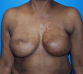 Patient 344 - Surgery 3 Photo 3 - Revisional Breast Surgery Tissue Expander Implant Latissimus Muscle - Breast Cancer Texas