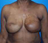 Patient 344 - Surgery 3 Photo 3 - Revisional Breast Surgery Tissue Expander Implant Latissimus Muscle - Breast Cancer Texas