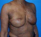 Patient 344 - Surgery 3 Photo 4 - Revisional Breast Surgery Tissue Expander Implant Latissimus Muscle - Breast Cancer Texas
