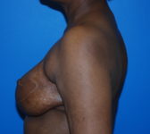 Patient 344 - Surgery 4 Photo 1 - Revisional Breast Surgery Tissue Expander Implant Latissimus Muscle - Breast Cancer Texas