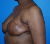 Patient 344 - Surgery 4 Photo 2 - Revisional Breast Surgery Tissue Expander Implant Latissimus Muscle - Breast Cancer Texas