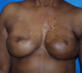 Patient 344 - Surgery 4 Photo 3 - Revisional Breast Surgery Tissue Expander Implant Latissimus Muscle - Breast Cancer Texas