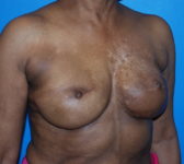 Patient 344 - Surgery 4 Photo 4 - Revisional Breast Surgery Tissue Expander Implant Latissimus Muscle - Breast Cancer Texas