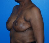 Patient 344 - Surgery 5 Photo 2 - Revisional Breast Surgery Tissue Expander Implant Latissimus Muscle - Breast Cancer Texas