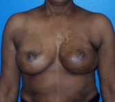 Patient 344 - Surgery 5 Photo 3 - Revisional Breast Surgery Tissue Expander Implant Latissimus Muscle - Breast Cancer Texas