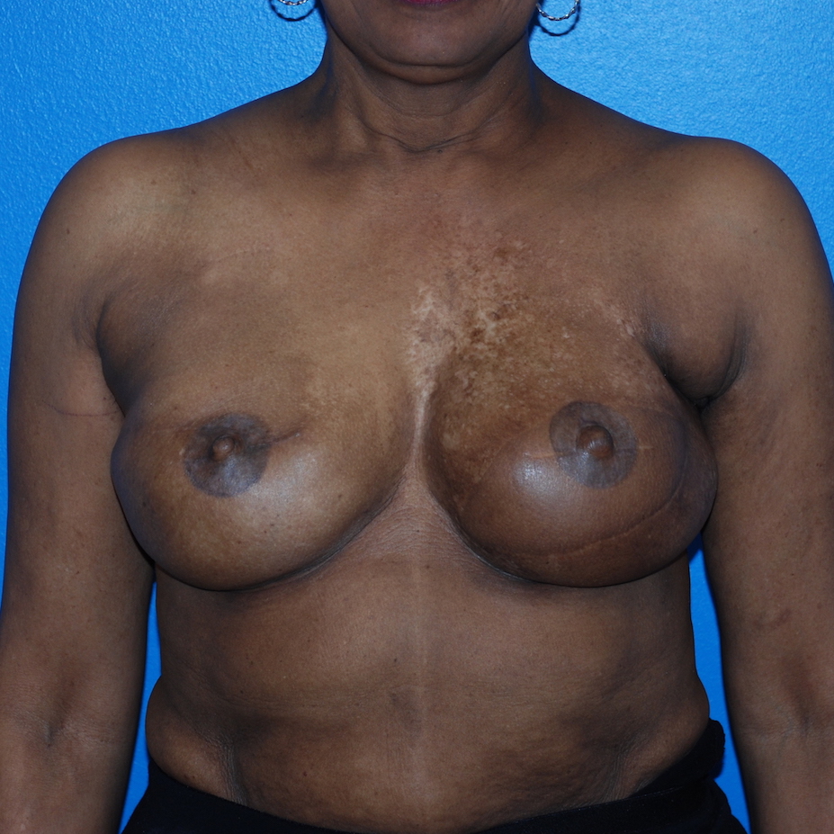 Patient 344 After Overview - Sidebar - Revisional Breast Surgery Tissue Expander Implant Latissimus Muscle - Breast Cancer Texas