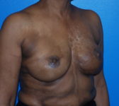 Patient 344 - Surgery 5 Photo 4 - Revisional Breast Surgery Tissue Expander Implant Latissimus Muscle - Breast Cancer Texas
