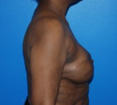 Patient 344 - Surgery 5 Photo 5 - Revisional Breast Surgery Tissue Expander Implant Latissimus Muscle - Breast Cancer Texas