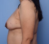 Patient 24 Before Surgey Photo 1 - DIEP Flap Surgery - Breast Cancer Texas