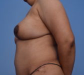 Patient 24 - Surgery 1 Photo 1 - DIEP Flap Surgery - Breast Cancer Texas