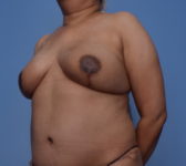 Patient 24 - Surgery 1 Photo 2 - DIEP Flap Surgery - Breast Cancer Texas