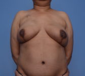 Patient 24 - Surgery 1 Photo 3 - DIEP Flap Surgery - Breast Cancer Texas