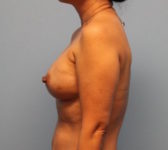 Patient 580 Before Surgey Photo 1 - Nipple Sparing Mastectomy Tissue Expander Implant - Breast Cancer Texas