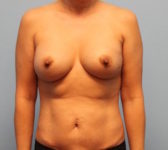 Patient 580 Before Overview - Nipple Sparing Mastectomy Tissue Expander Implant - Breast Cancer Texas