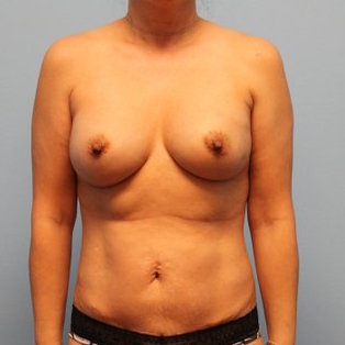 Patient 580 Before Overview - Sidebar - Nipple Sparing Mastectomy Tissue Expander Implant - Breast Cancer Texas