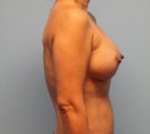 Patient 580 Before Surgey Photo 5 - Nipple Sparing Mastectomy Tissue Expander Implant - Breast Cancer Texas